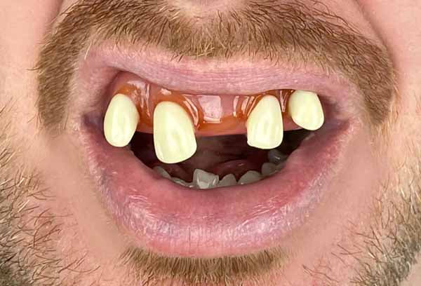 Billy Bob Tiger Novelty Teeth
